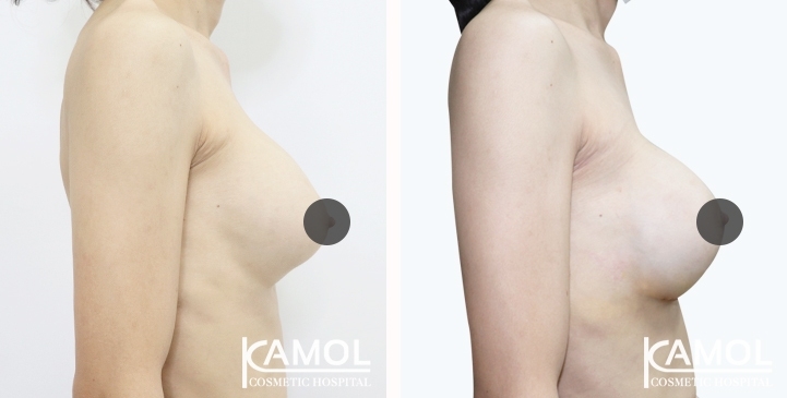 Before and After breast implant revision