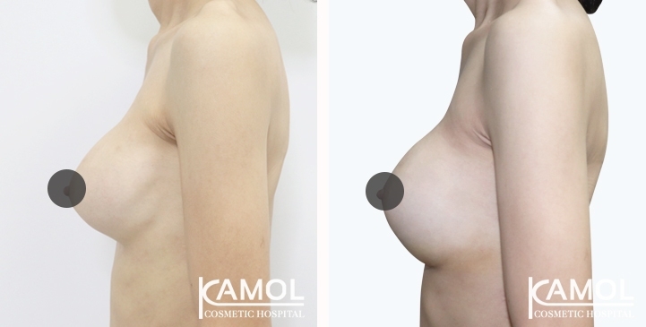 Before and After breast implant revision