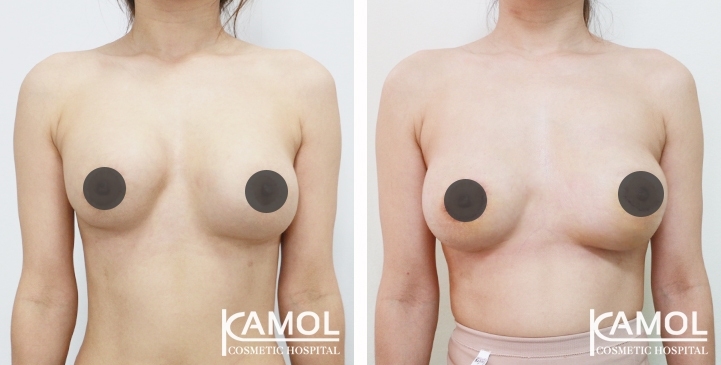 Before and After breast implant revision