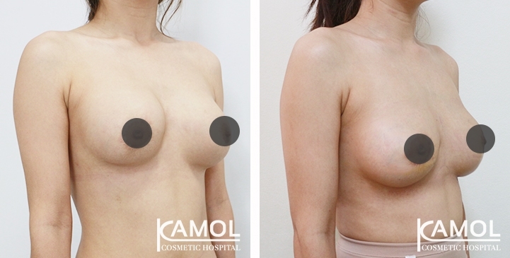 Before and After breast implant revision