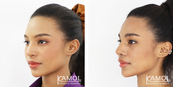 Before and After Rhinoplasty, Nose Job, Nose Surgery