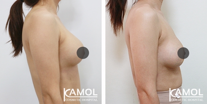 Before and After breast implant revision