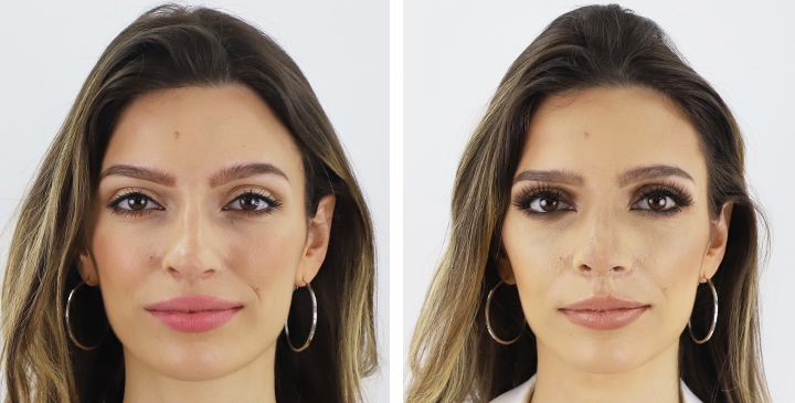 Before and After Rhinoplasty, Nose Job, Nose Surgery