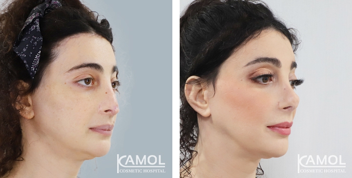 Before and After Rhinoplasty, Nose Job, Nose Surgery