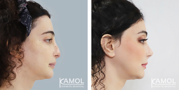 Before and After Rhinoplasty, Nose Job, Nose Surgery