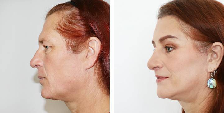 Before and After Augmentation Rhinoplasty, Nose Job, Nose Surgery