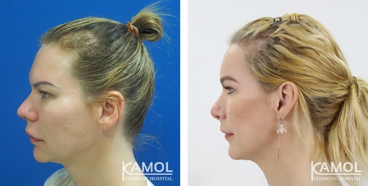 Before and After Rhinoplasty, Nose Job, Nose Surgery