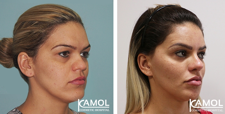 Before and After Rhinoplasty, Nose Job, Nose Surgery