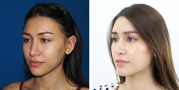 Before and After Rhinoplasty, Nose Job, Nose Surgery