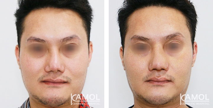 Before and After Revision Augmentation Rhinoplasy, Nose Job, Nose Surgery