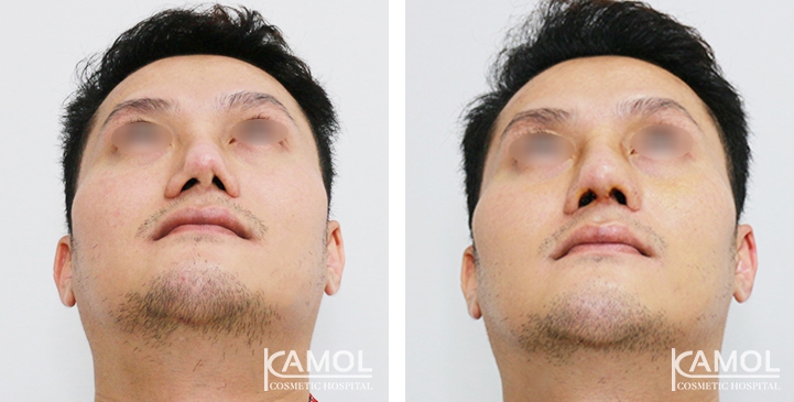 Before and After Revision Augmentation Rhinoplasy, Nose Job, Nose Surgery