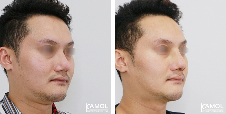 Before and After Revision Augmentation Rhinoplasy, Nose Job, Nose Surgery