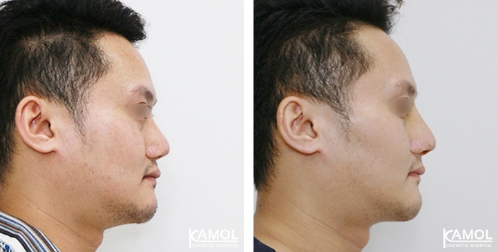 Before and After Revision Augmentation Rhinoplasy, Nose Job, Nose Surgery