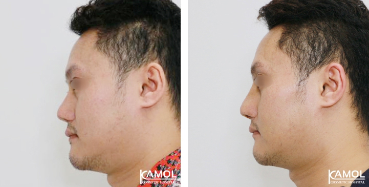 Before and After Revision Augmentation Rhinoplasy, Nose Job, Nose Surgery