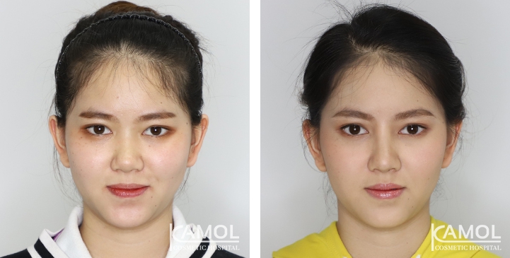 Before and After Augmentation Rhinoplasty, Nose Job, Nose Surgery