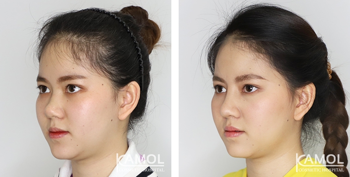 Before and After Augmentation Rhinoplasty, Nose Job, Nose Surgery