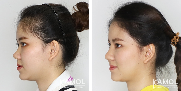 Before and After Augmentation Rhinoplasty, Nose Job, Nose Surgery