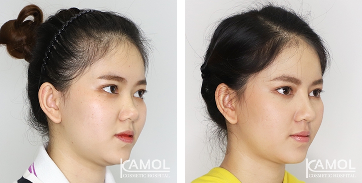 Before and After Augmentation Rhinoplasty, Nose Job, Nose Surgery