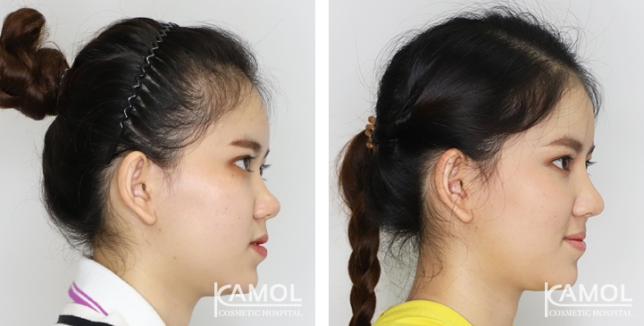 Before and After Augmentation Rhinoplasty, Nose Job, Nose Surgery