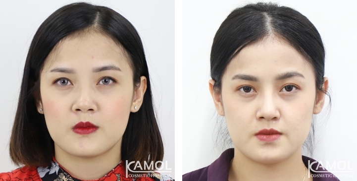 Before and After Augmentation Rhinoplasty, Nose Job, Nose Surgery