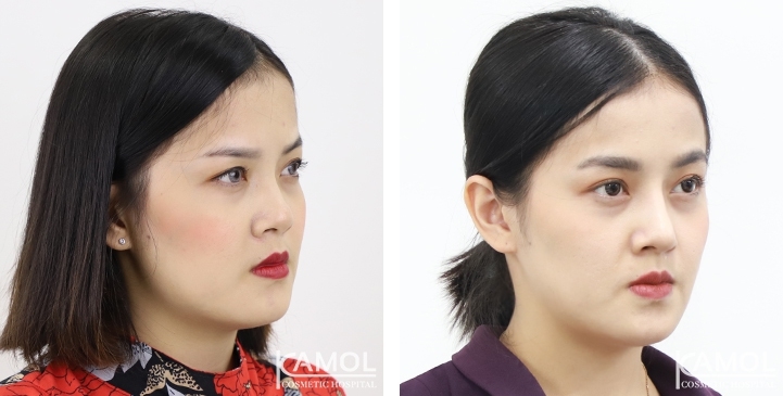 Before and After Augmentation Rhinoplasty, Nose Job, Nose Surgery