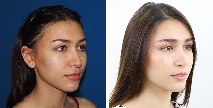 Before and After Augmentation Rhinoplasty, Nose Job, Nose Surgery