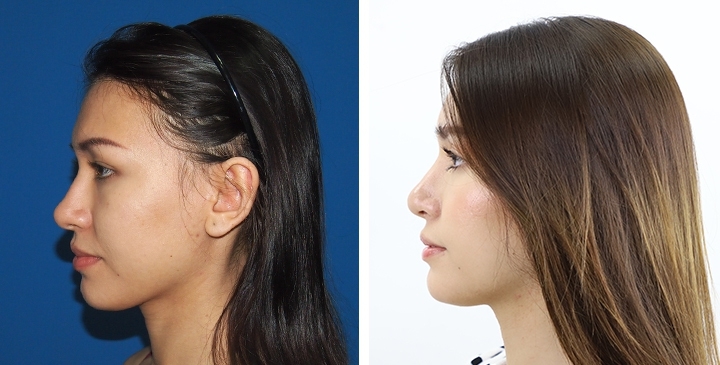 Before and After Augmentation Rhinoplasty, Nose Job, Nose Surgery