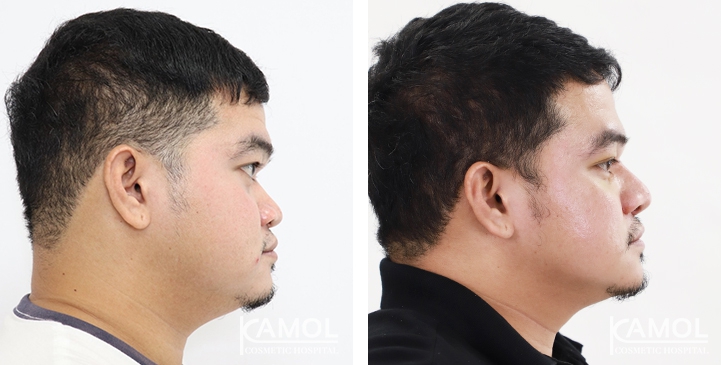 Before and After Augmentation Rhinoplasty, Nose Job, Nose Surgery