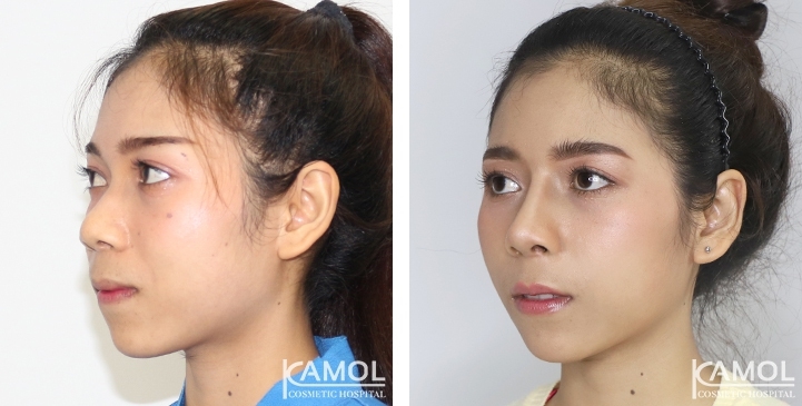 Before and After Augmentation Rhinoplasty, Nose Job, Nose Surgery