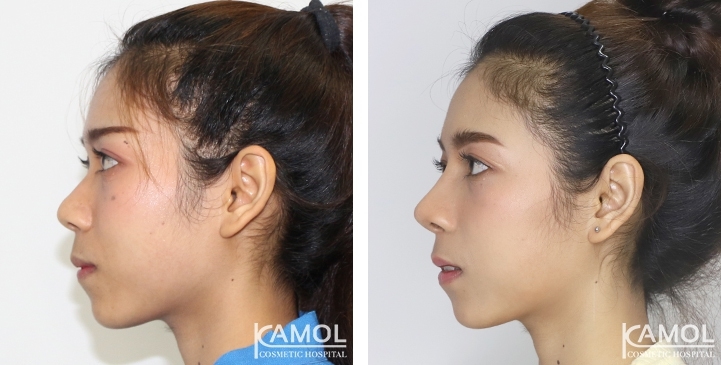 Before and After Augmentation Rhinoplasty, Nose Job, Nose Surgery