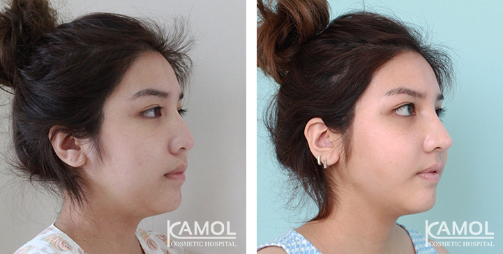 Before and After Augmentation Rhinoplasty, Nose Job, Nose Surgery