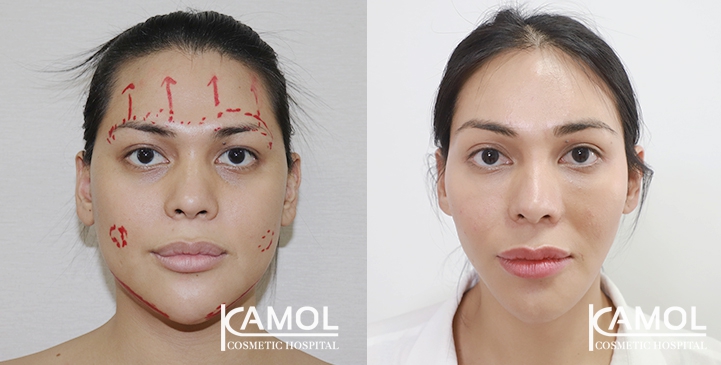 Jaw reduction, Forehead contouring, Eye brow lift