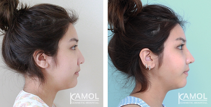 Before and After Augmentation Rhinoplasty, Nose Job, Nose Surgery