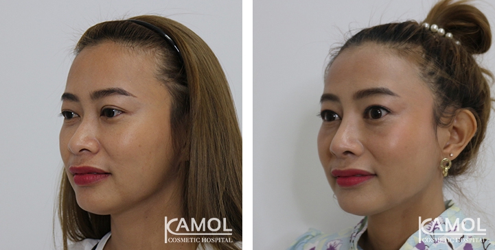 Before and After Augmentation Rhinoplasty, Nose Job, Nose Surgery