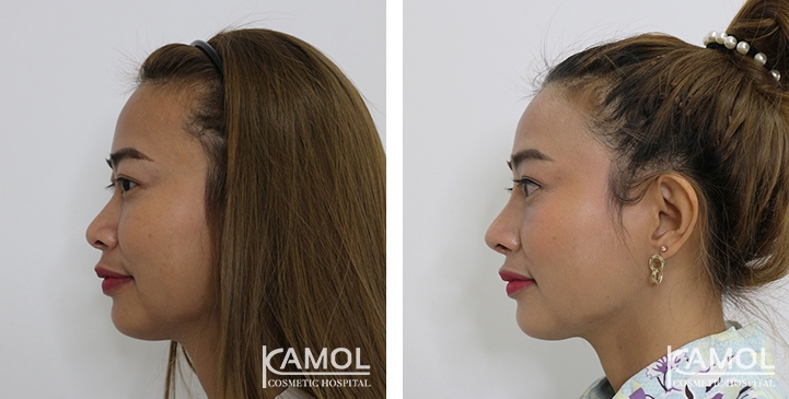 Before and After Augmentation Rhinoplasty, Nose Job, Nose Surgery