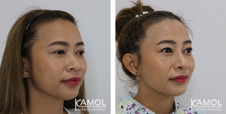 Before and After Augmentation Rhinoplasty, Nose Job, Nose Surgery