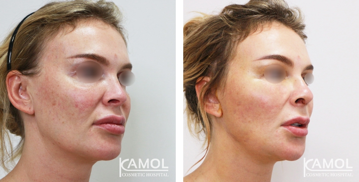 Before and After Augmentation Rhinoplasty, Nose Job, Nose Surgery  with Rib Cartilage
