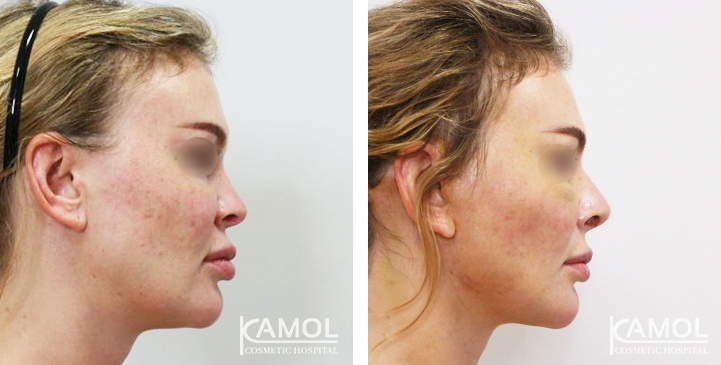 Before and After Augmentation Rhinoplasty, Nose Job, Nose Surgery  with Rib Cartilage