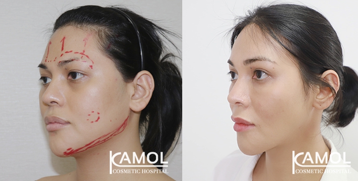 Jaw reduction, Forehead contouring, Eye brow lift