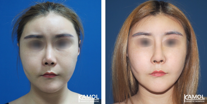 Before and After Augmentation Rhinoplasty, Nose Job, Nose Surgery  with Rib Cartilage