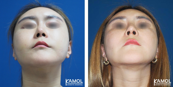 Before and After Augmentation Rhinoplasty, Nose Job, Nose Surgery  with Rib Cartilage