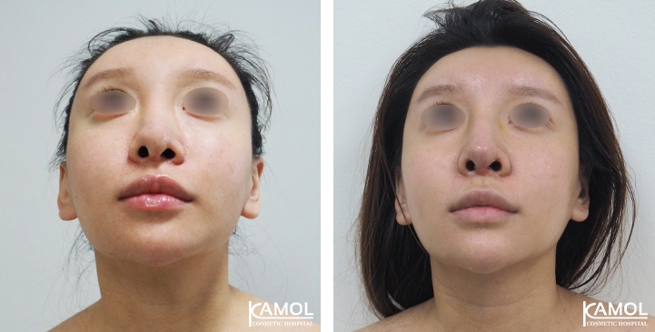 Before and After Augmentation Rhinoplasty, Nose Job, Nose Surgery  with Rib Cartilage