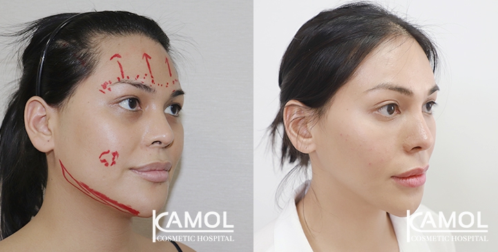 Jaw reduction, Forehead contouring, Eye brow lift