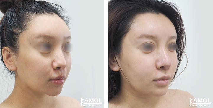 Before and After Augmentation Rhinoplasty, Nose Job, Nose Surgery  with Rib Cartilage