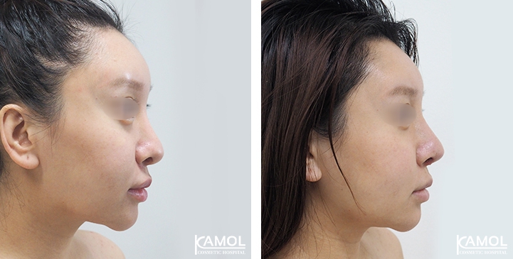 Before and After Augmentation Rhinoplasty, Nose Job, Nose Surgery  with Rib Cartilage