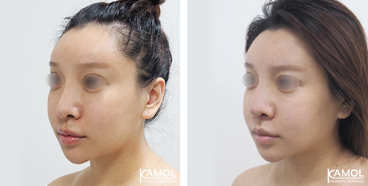 Before and After Augmentation Rhinoplasty, Nose Job, Nose Surgery  with Rib Cartilage