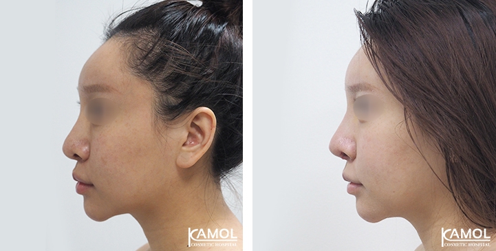 Before and After Augmentation Rhinoplasty, Nose Job, Nose Surgery  with Rib Cartilage