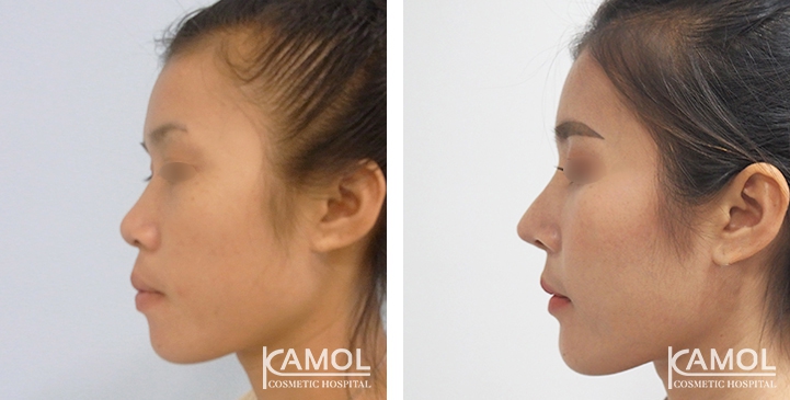 Before and After Augmentation Rhinoplasty, Nose Job, Nose Surgery  with e-PTFE Gore-Tex