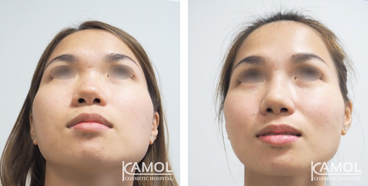 Before and After Augmentation Rhinoplasty, Nose Job, Nose Surgery  with e-PTFE Gore-Tex