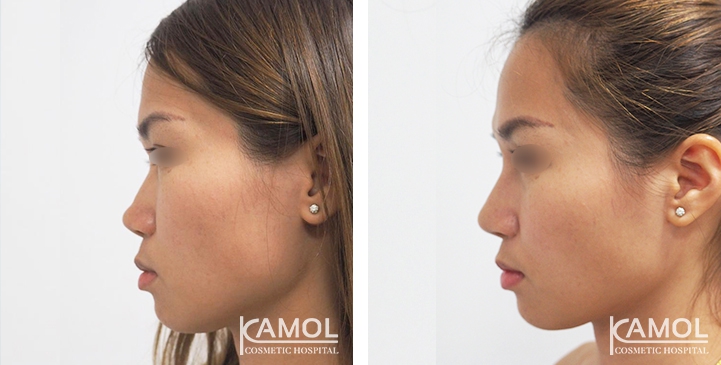 Before and After Augmentation Rhinoplasty, Nose Job, Nose Surgery  with e-PTFE Gore-Tex